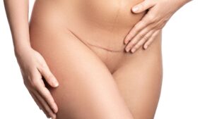 what a tummy tuck scar is like