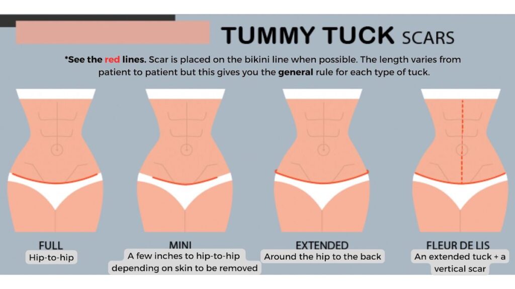 what is a tummy tuck scar is like