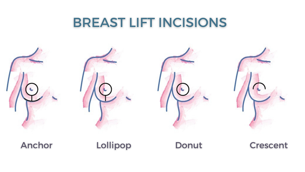 breast lift las vegas