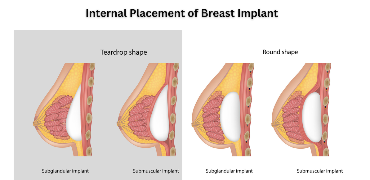 breast augmentation las vegas