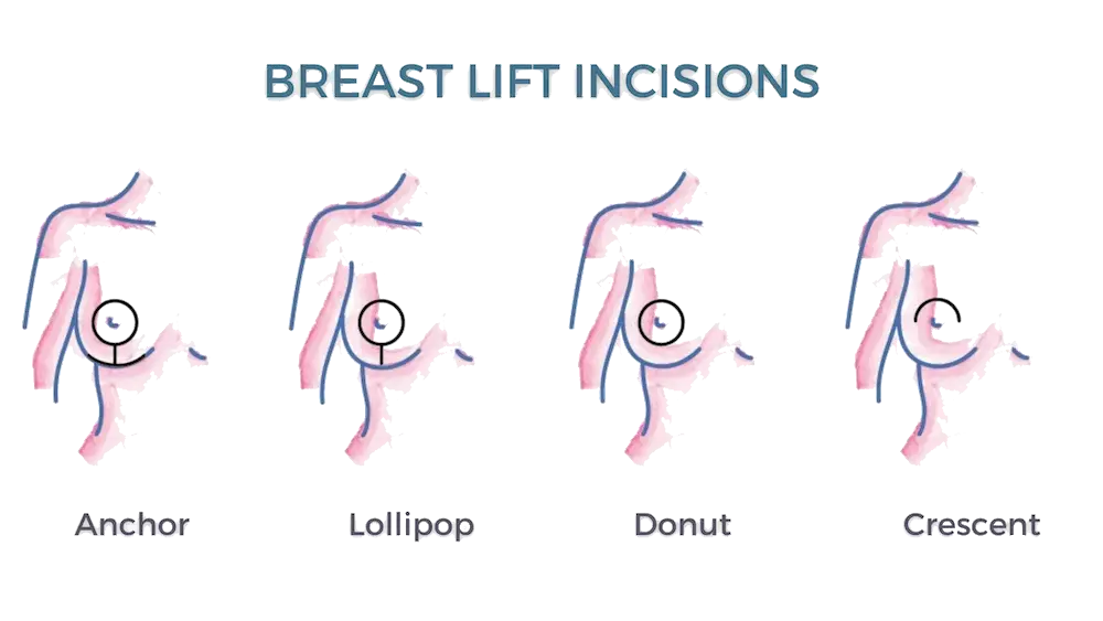 Four Types of Breast Reduction